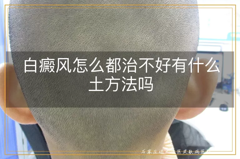白癜风怎么都治不好有什么土方法吗