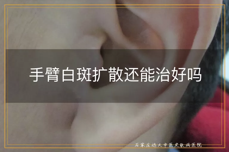 手臂白斑扩散还能治好吗