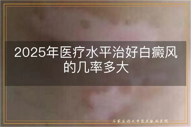 2025年医疗水平治好白癜风的几率多大