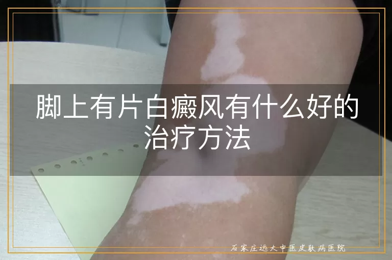 脚上有片白癜风有什么好的治疗方法