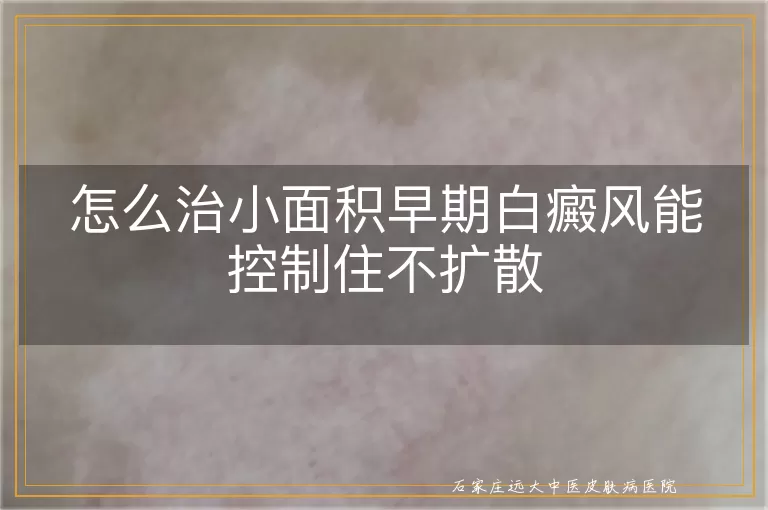 怎么治小面积早期白癜风能控制住不扩散