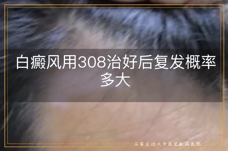 白癜风用308治好后复发概率多大