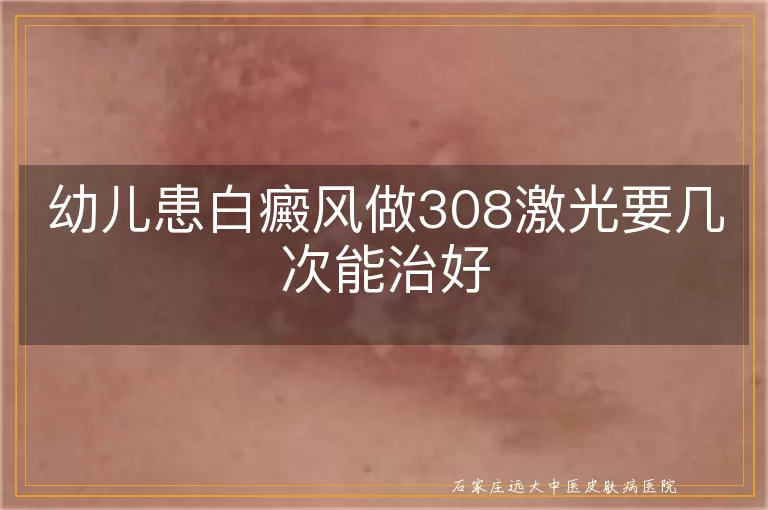幼儿患白癜风做308激光要几次能治好