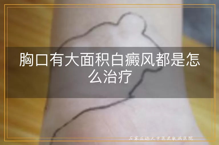 胸口有大面积白癜风都是怎么治疗