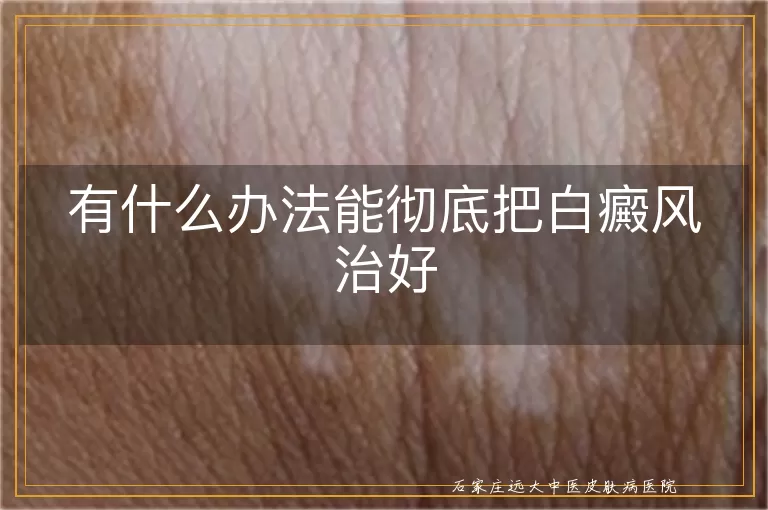 有什么办法能彻底把白癜风治好