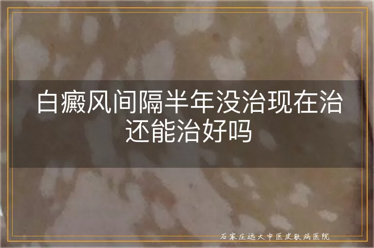 白癜风间隔半年没治现在治还能治好吗