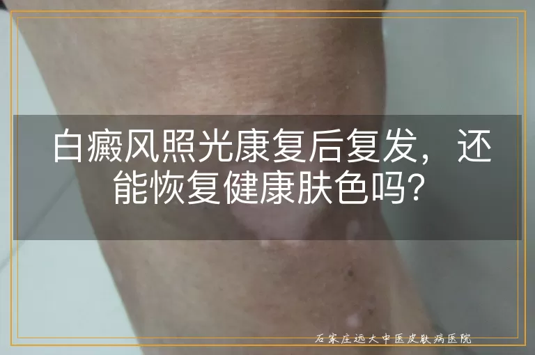 白癜风照光康复后复发,还能恢复健康肤色吗?