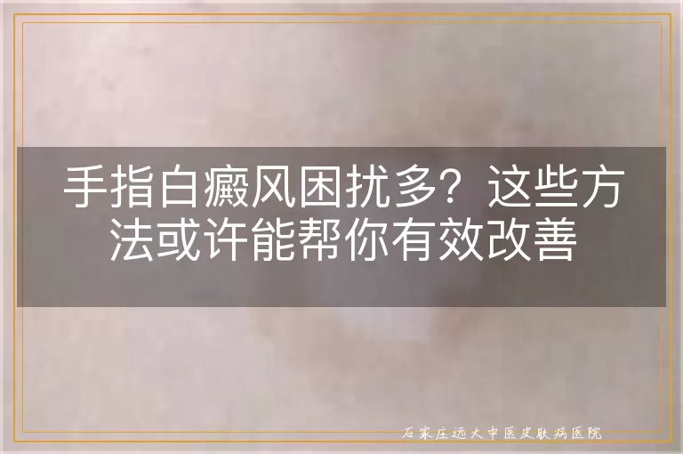 手指白癜风困扰多？这些方法或许能帮你有效改善