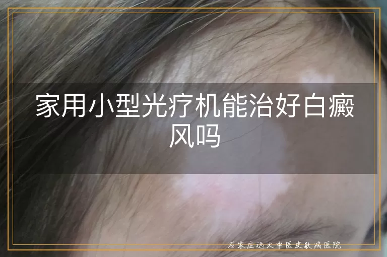 家用小型光疗机能治好白癜风吗