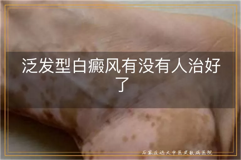 泛发型白癜风有没有人治好了
