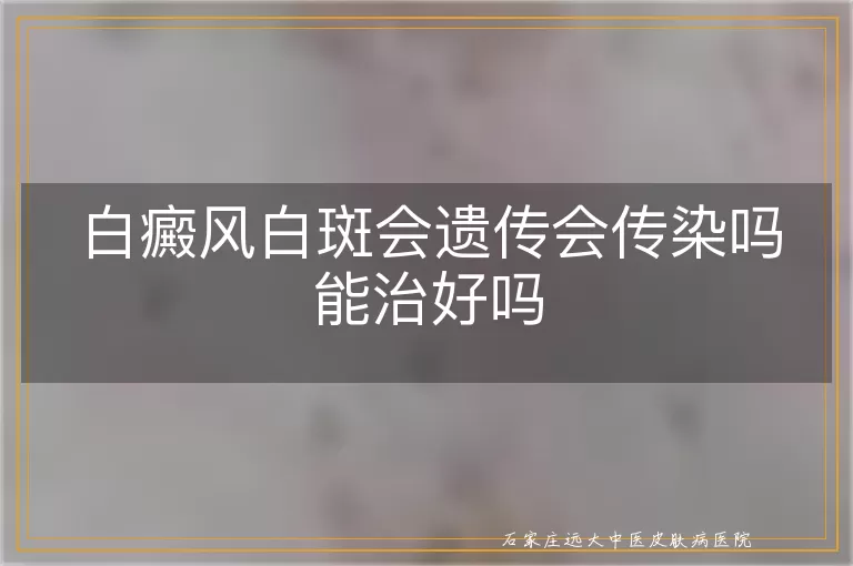 白癜风白斑会遗传会传染吗能治好吗