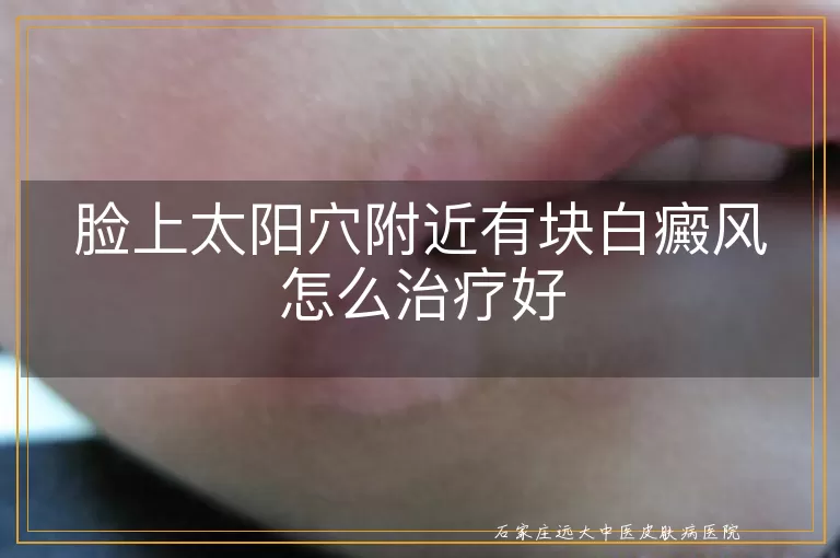 脸上太阳穴附近有块白癜风怎么治疗好