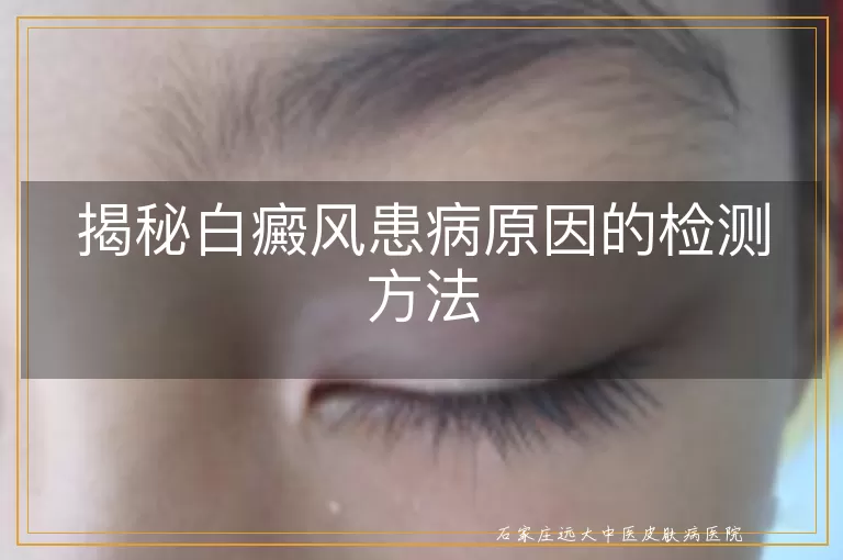 揭秘白癜风患病原因的检测方法