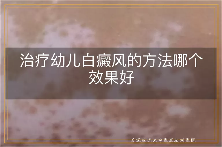 治疗幼儿白癜风的方法哪个效果好