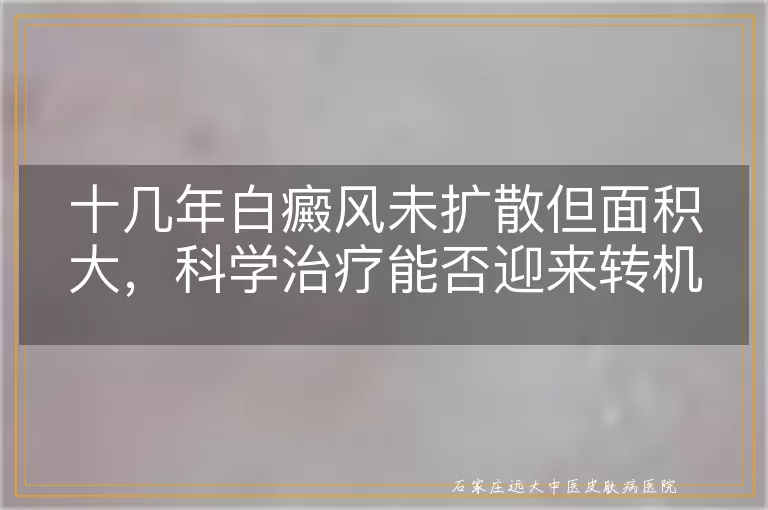 十几年白癜风未扩散但面积大，科学治疗能否迎来转机？
