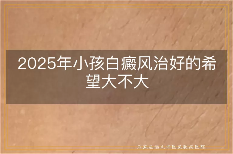 2025年小孩白癜风治好的希望大不大
