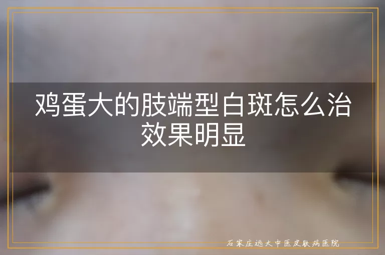 鸡蛋大的肢端型白斑怎么治效果明显