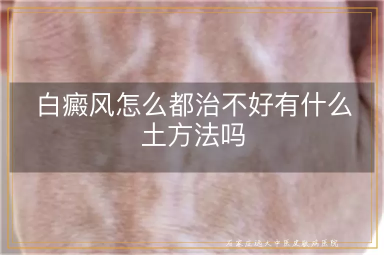 白癜风怎么都治不好有什么土方法吗