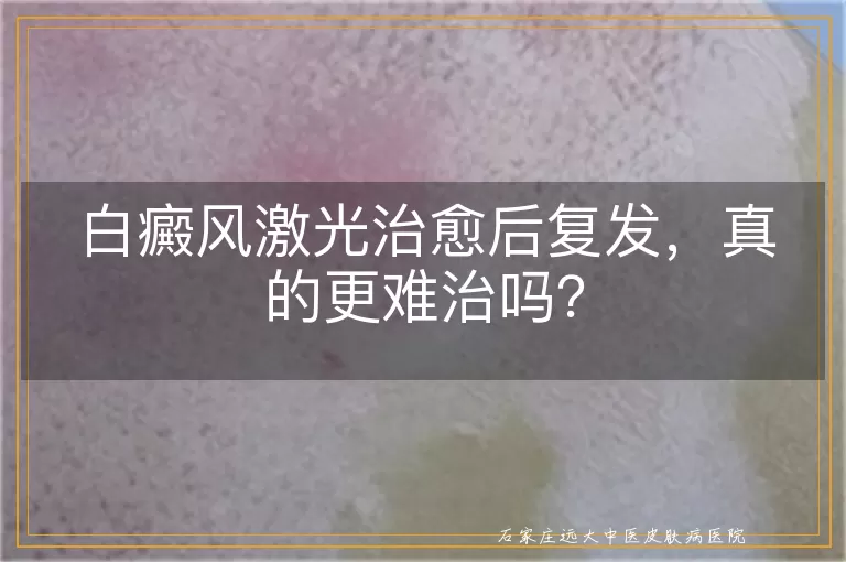 白癜风激光治愈后复发，真的更难治吗？