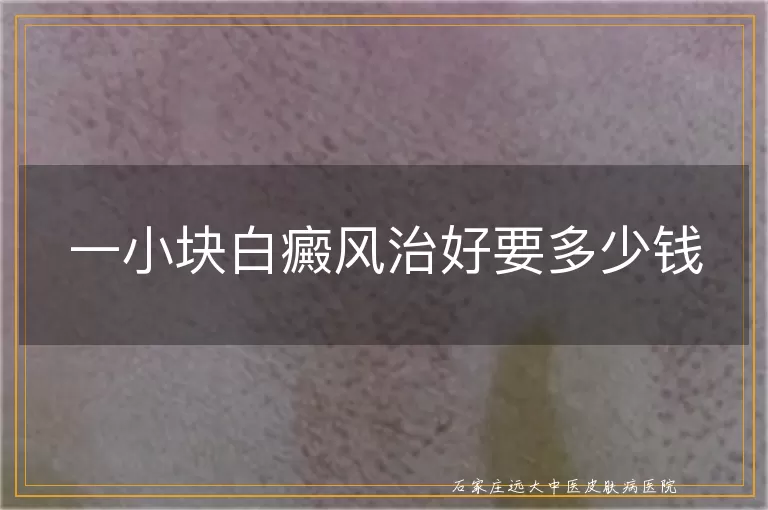 一小块白癜风治好要多少钱