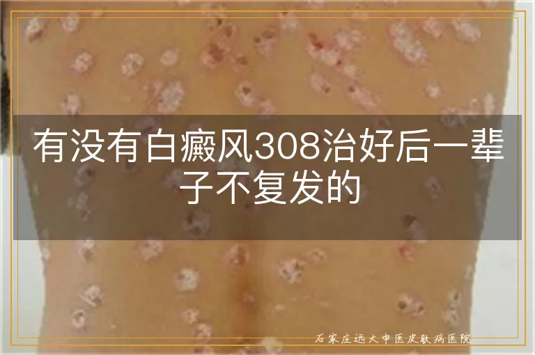 有没有白癜风308治好后一辈子不复发的