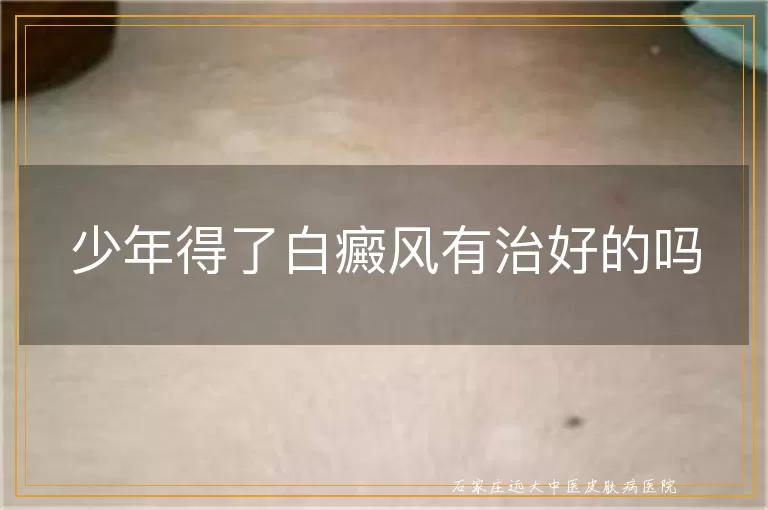 少年得了白癜风有治好的吗