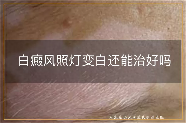 白癜风照灯变白还能治好吗