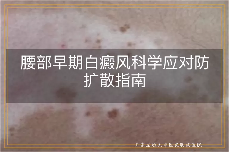 腰部早期白癜风科学应对防扩散指南