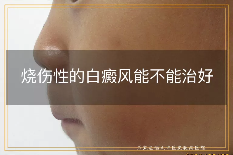 烧伤性的白癜风能不能治好