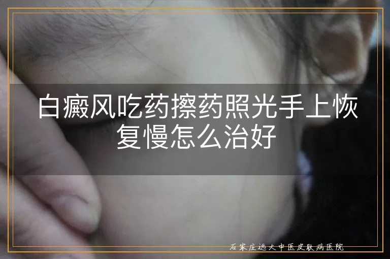 白癜风吃药擦药照光手上恢复慢怎么治好