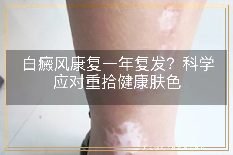白癜风康复一年复发？科学应对重拾健康肤色