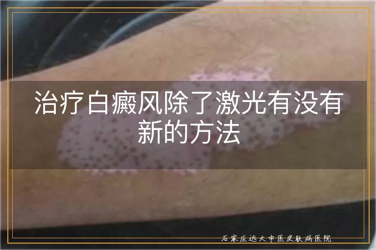 治疗白癜风除了激光有没有新的方法