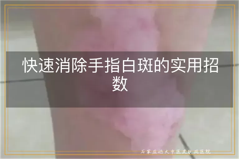 快速消除手指白斑的实用招数