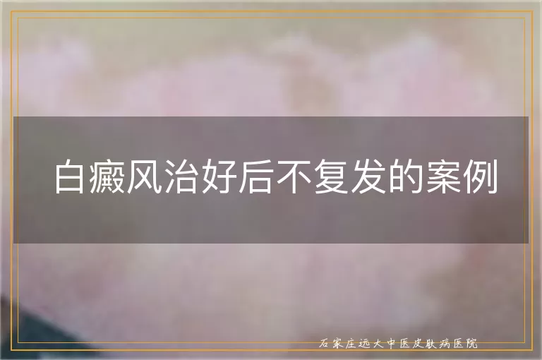 白癜风治好后不复发的案例