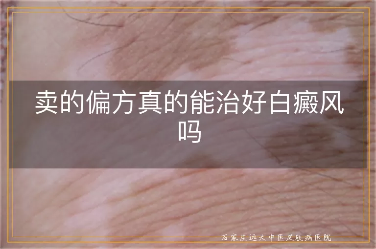 卖的偏方真的能治好白癜风吗