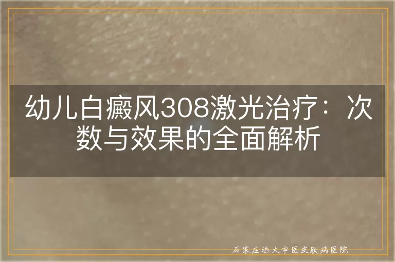 幼儿白癜风308激光治疗:次数与效果的全面解析