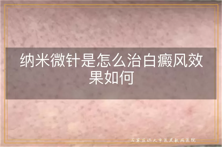 纳米微针是怎么治白癜风效果如何
