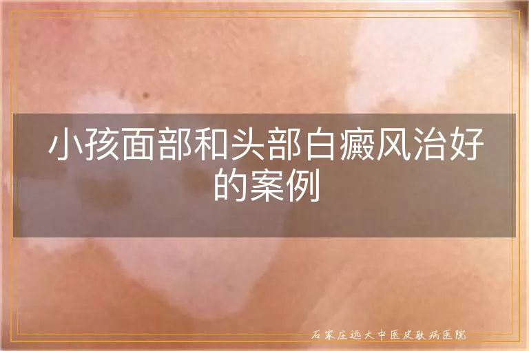 小孩面部和头部白癜风治好的案例