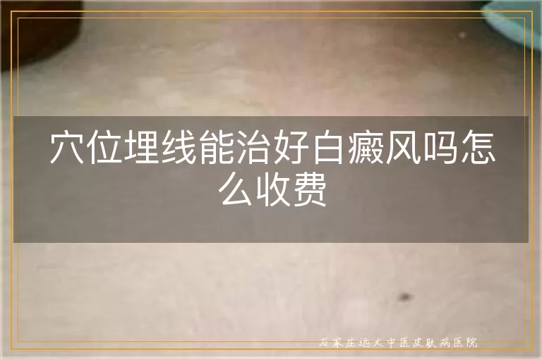 穴位埋线能治好白癜风吗怎么收费