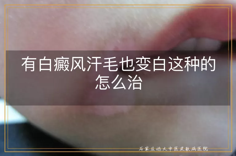 有白癜风汗毛也变白这种的怎么治