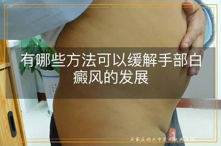 有哪些方法可以缓解手部白癜风的发展