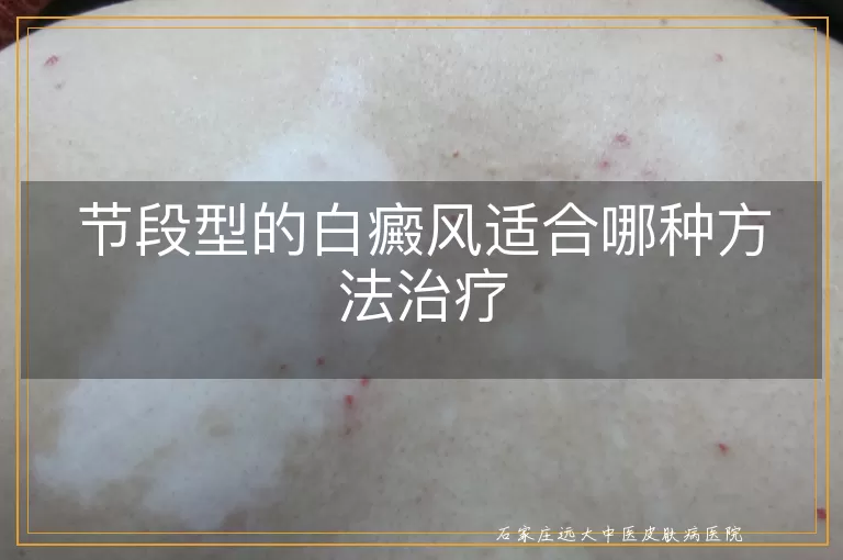节段型的白癜风适合哪种方法治疗