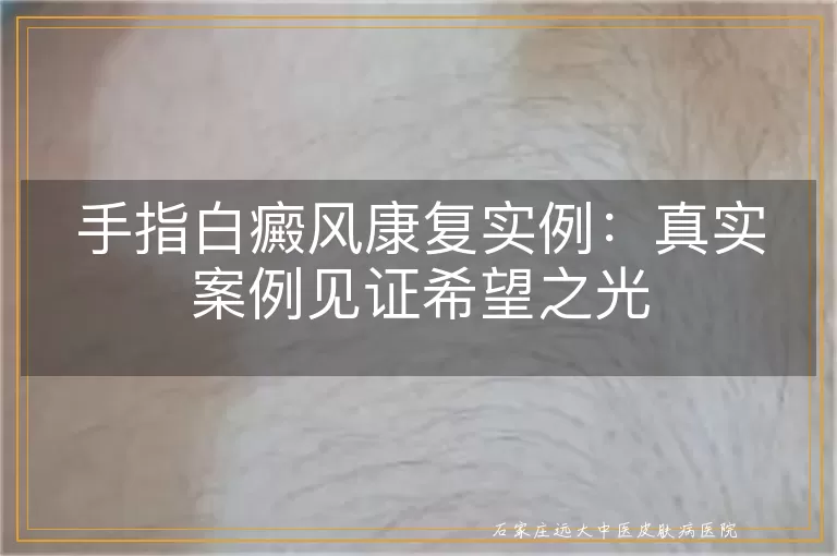 手指白癜风康复实例:真实案例见证希望之光