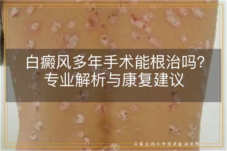 白癜风多年手术能根治吗？专业解析与康复建议