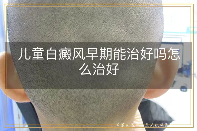 儿童白癜风早期能治好吗怎么治好