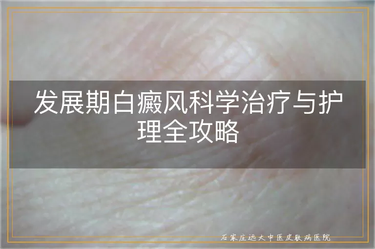 发展期白癜风科学治疗与护理全攻略