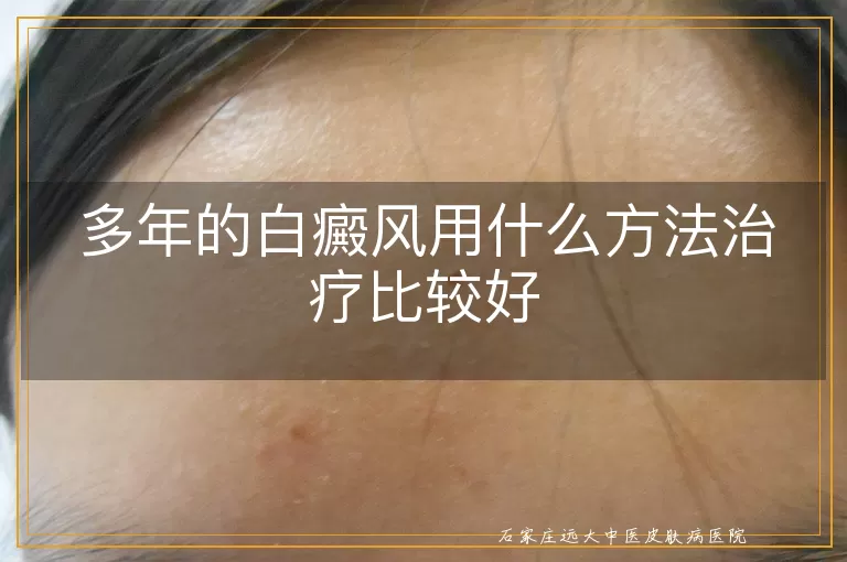 多年的白癜风用什么方法治疗比较好