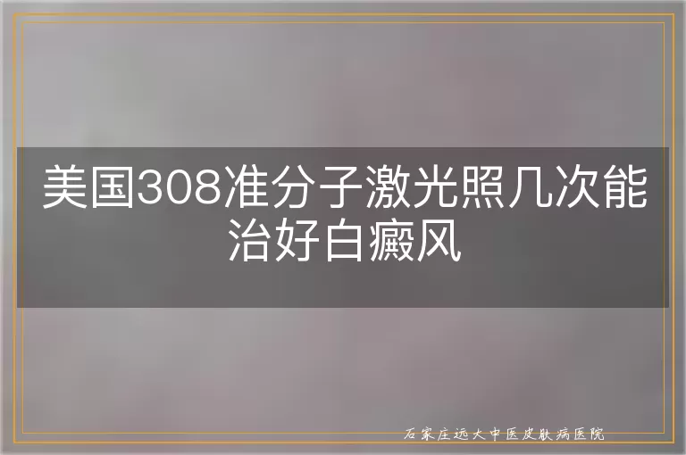 美国308准分子激光照几次能治好白癜风