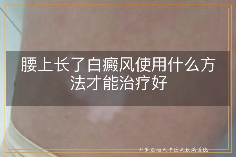 腰上长了白癜风使用什么方法才能治疗好