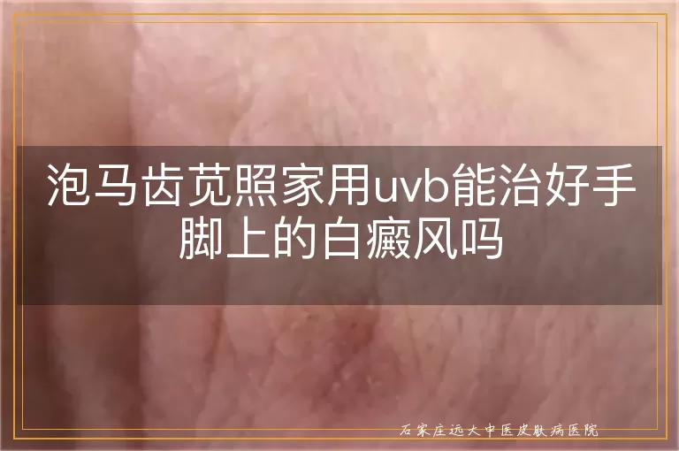 泡马齿苋照家用uvb能治好手脚上的白癜风吗